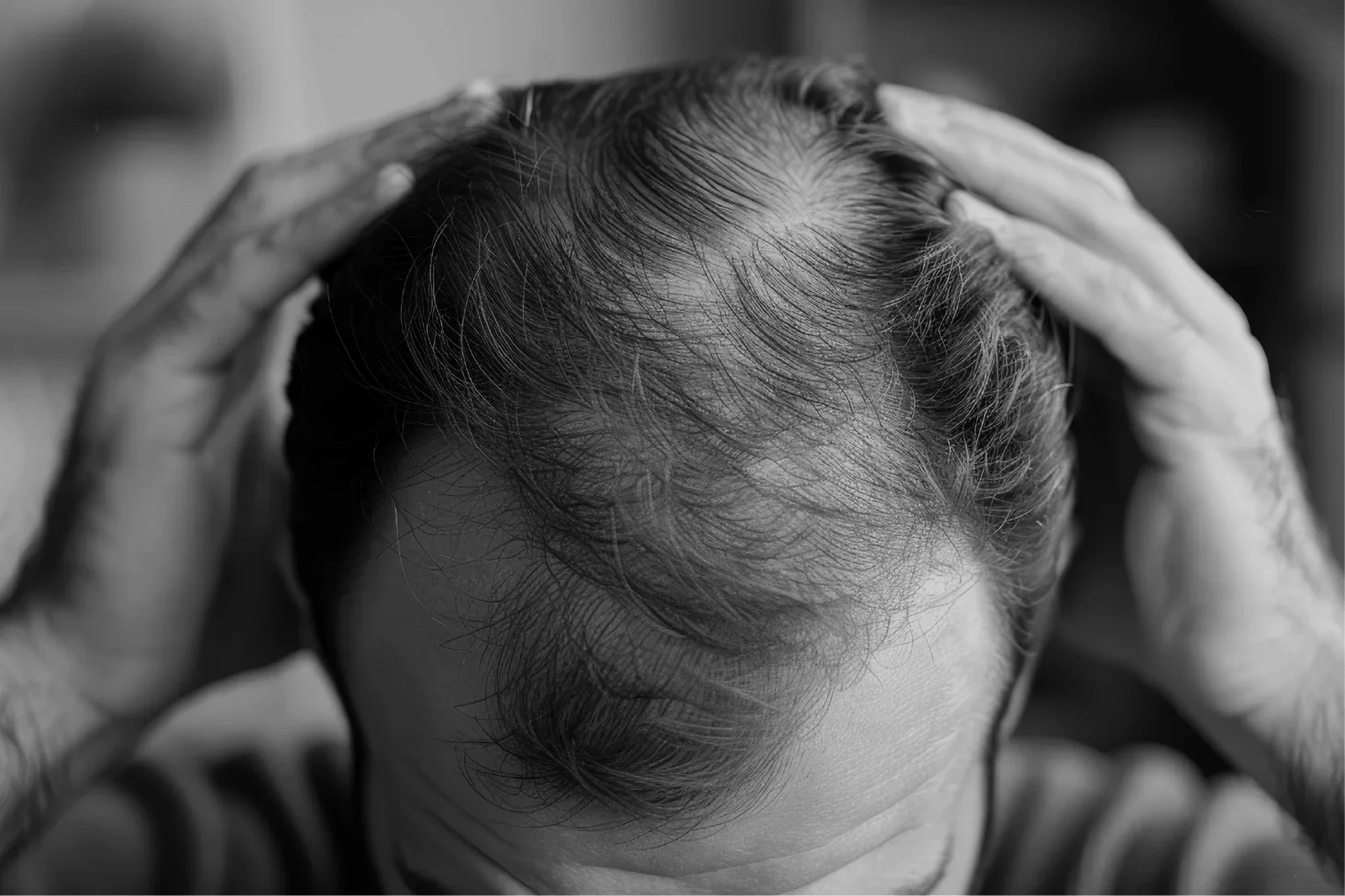 ¿Cuál es tu tipo de alopecia? Descúbrelo antes de que avance - Pharma Grow