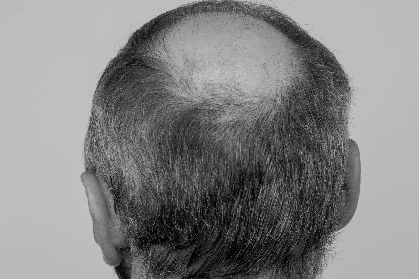 ¿Entradas o coronilla? Descubre dónde empieza realmente tu caída de cabello - Pharma Grow
