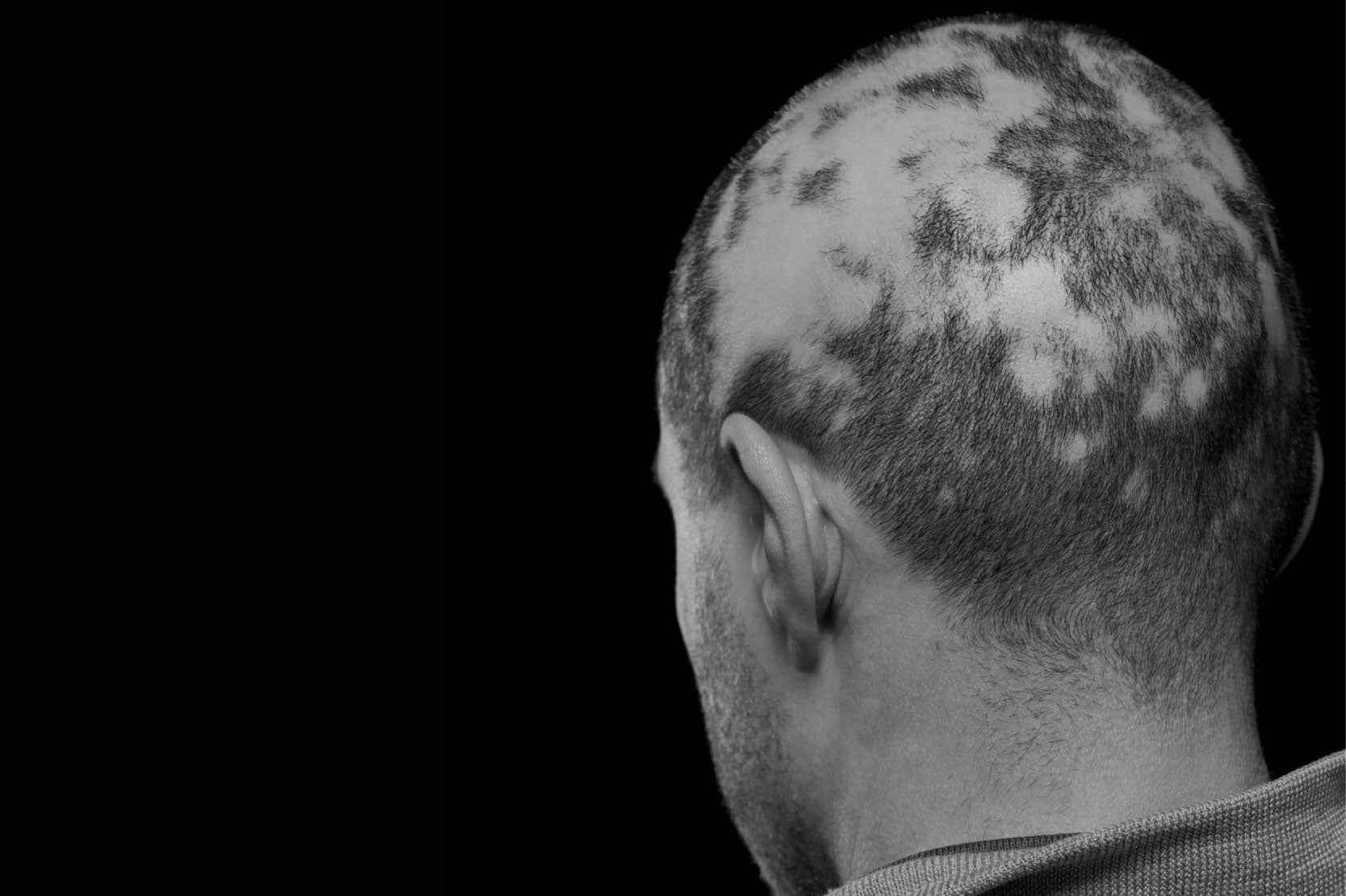 Tipos de alopecia y qué usar según tu caso - Pharma Grow