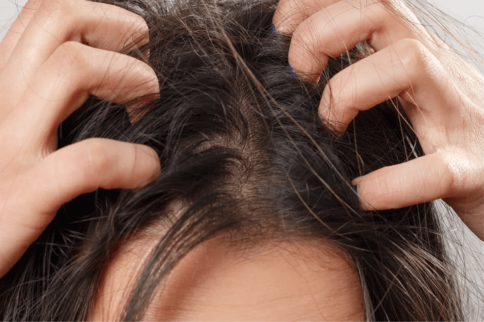 Alopecia femenina: Datos que probablemente desconocías. - Pharma Grow