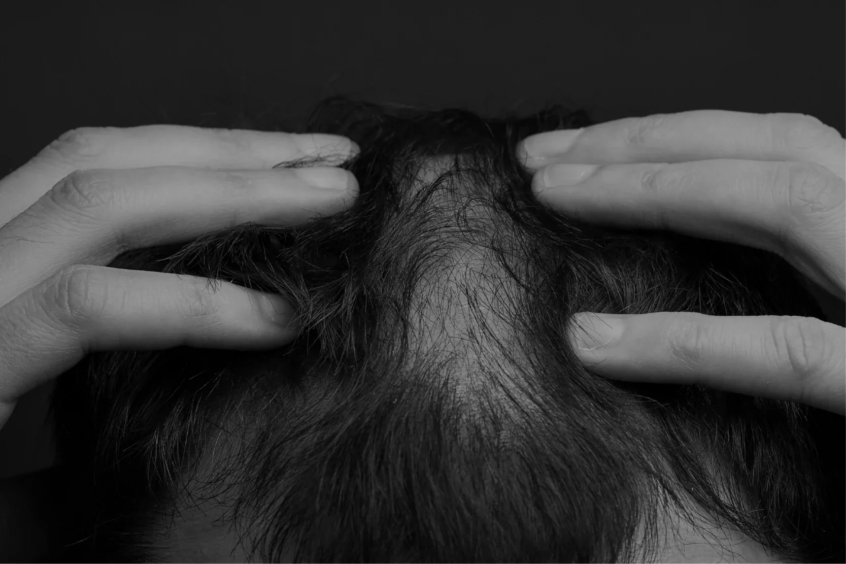 Si dejo el tratamiento de Minoxidil ¿pierdo todo el avance? - Pharma Grow