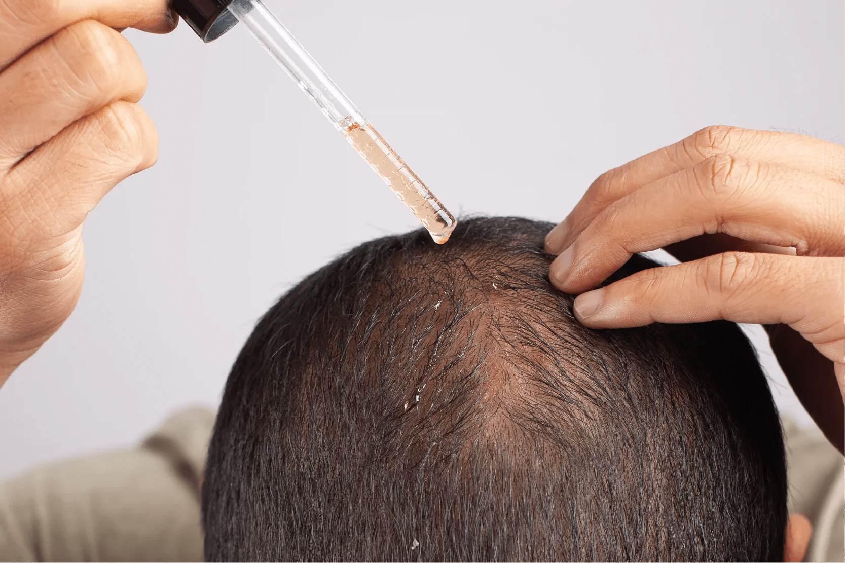 Minoxidil vs Finasteride: ¿Cuál es la diferencia? - Pharma Grow