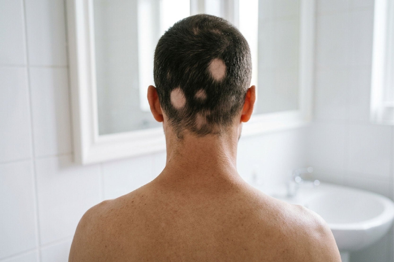 ¿Te apareció una zona redonda sin cabello? Podría ser alopecia areata - Pharma Grow