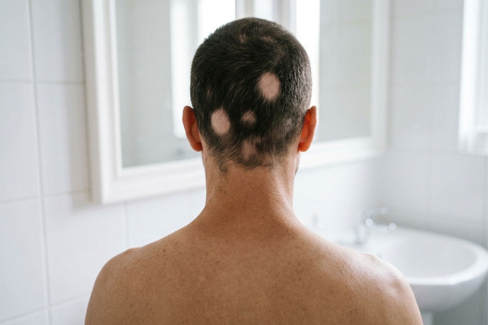 ¿Te apareció una zona redonda sin cabello? Podría ser alopecia areata